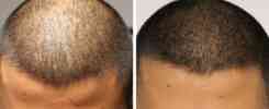 scalp-micropigmentation